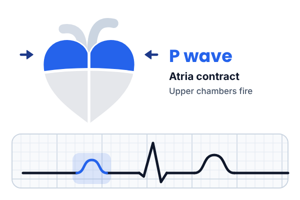 Heart with the upper chambers (atria) highlighted in blue beside an ECG trace with the P wave in blue